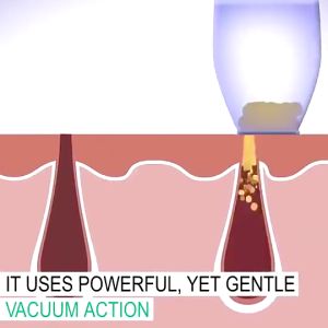 Face Vacuum Pore Cleanser Pembersih Wajah Penyedot Komedo Alat Perawatan Wajah Elektrik 202-8