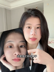 คลิปจมูกความงาม อุปกรณ์ซิลิโคนจมูก เครื่องมือไสจมูกซิลิโคนทางการแพทย์พร้อมลวดปรับได้ ไม่มีความเจ็บปวดเจ็บเครื่องมือความงาม ใช้งานง่ายปลอดภัยไร้สารเคมี