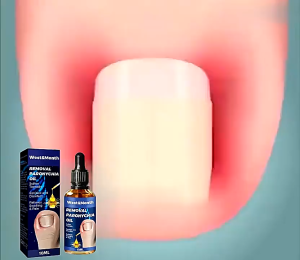 10ml Onychomycosis Treatment Cream Anti-Paronychia Contains Herbal Extracts To Treat Onychomycosis Caused By Fungal Infection Such As Atrophy Unevenness Thickening Breakage Yellowing And Shedding Gentle And Painless Enhanced Repair