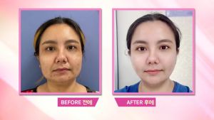 คุ้มสุดๆ10 แถม10 Barcony Lifting Perfect ครีมยกกระชับผิวหน้า ฟรี!!! Barcony Night Repairing ครีมลดปัญหาฝ้าแดด นวัตกรรมความงามจากเกาหลี