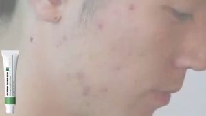 กำจัดสิว 20ML ซึ่งไม่ระคาย อ่อนโยน เจลแต้มสิว สลายสิวอุดตันที่ต้นตอ