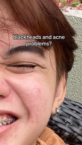 ICE LERSKIN Toner 7% Glycolic Acid Whitening and Exfoliate Skincare Remove Blackheads Shrink Pores