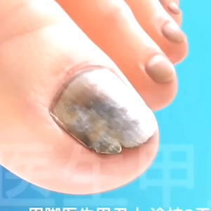 Serum Hỗ trợ giảm nấm móng tay Nâng cao Dễ sử dụng Nấm móng tay tự nhiên