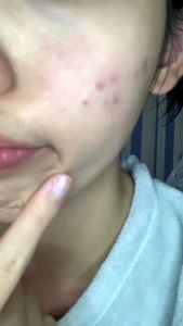 Salicylic Acid Acne Cream Remove Blackhead Oil Control Anti-Acne Treatment Repair Pimple Acne Scar Whitening Face Cream Skincare 20g
