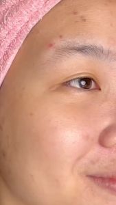 SCARLETT Cream Series - Brightly Ever After | Acne