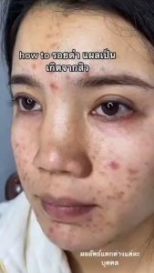 Infresh เซรั่มหลุมสิว ขนาด 30 มล รูขุมขนกระชับ สูตรเร่งรัด สารสกัดจากธรรมชาติ การวิจัย Muco ลดรอยแดง ลดรอย ปรับให้ผิวกระจ่างใส