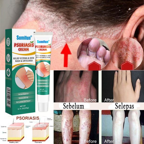 Original Sumifun Psoriasis Eczema Cream Antibacterial Anti-itching ...