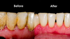 Electric Toothbrush+Ultrasonic Cleaning And Tartar Removal Stones And Fresh Breath Gum Protection Tooth Cleaner (send ยาสีฟัน) +แปรงสีฟันไฟฟ้าสำหรับใช้ในครัวเรือน USB Electric Beauty Artifact Replaceable Brush Head Cleaner Package Health Care Tool