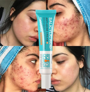 Salicylic Acid Acne Treatment Cream Repair Pimple Spots Serum Cleaning Pore Anti-acne Oil Control Moisturizer Smooth Skin Care