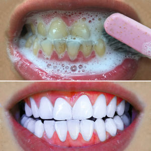 Teeth Whitening Probiotic Original toothpaste 120g removes bad breath Helicobacter flavus cavities Remove tartar Yellow teeth removal Smoking teeth Fresh breath Tooth Decay prevention Clean Tooth Stains Coffee Stains Smoke Stains Black Teeth