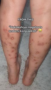 【MY Girl】Verdefy Scar Remover Cream For Stretchmarks Melasma & Pekas Lighten Scar Remove Dark Spot & Deak Skin Cells