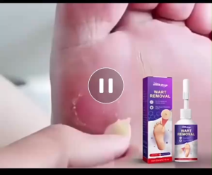 [Kem  Mụn Chân] Chiết Xuất 100% Từ Thiên Nhiên Giúp Loại Bỏ Mụn Cứng Đầu Hiệu Quả Dưỡng Da Mịn Màng Và An Toàn Cho Mọi Loại Da