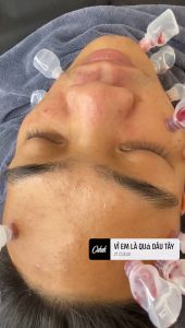 10 ống nhựa hút máu bầm 5ml 10ml chai hút máu bầm (combo 10 ống)