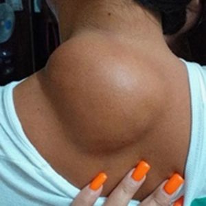 Lipoma Lump Bulge Removal Cream Ointment 30g Fat Granule Care Lipolysis Fat Lump External Swelling Cellulite lump Bulge Original Multiple Single Lipoma Subcutaneous Lipoma Lump Pain Relieving 99% ubat benjolan di leher 脂肪瘤膏 Krim