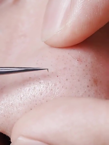 Stainless steel acne needle set No. 5 needle blackhead removal needle + cell clip to deal with acne blackheads efficiently5号针头黑头去除针+细胞夹