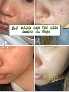 Kem Dưỡng Giảm Mụn Sáng Da Kracie Hadabisei Facial Cream (Acne Care) Nhật Bản 50g - virgot.store