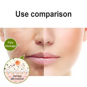 Images Advanced Fruit Acid Exfoliation Facial Scrub Deep Cleansing Peeling Gel Remove Dead Skin Blackhead果酸去角质啫喱