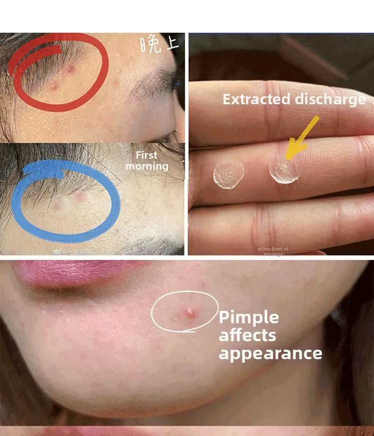 glutathione pimple patch MANYO 7 Dark Spot Serum (30 pieces) Salicylic Acid Glutathione Microneedle Acne