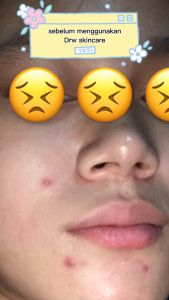 Serum wajah yang bagus untuk jerawat/ serum for acne Drwskincare