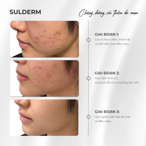 Gel chấm mụn Sulderm hỗ trợ giảm mụn sưng đỏ gom cồi mờ thâm sau mụn