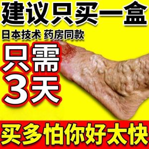 Vein Effect Varicose Veins Special Moxibustion Patch Red Blood Thread Hand Back Vein Blue Vein Prominence Swelling Pain