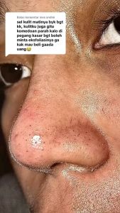 Paket Perawatan Kulit Sehat Cleora Exfo: Cepat & Efektif