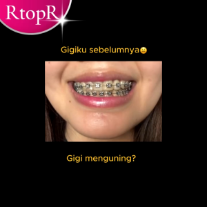 Bpom Perontok karang gigi paling ampuh Pembersih karang gigi berkerak Pembersih gigi kuning 30ml Penghilang bau mulut dan nafas FA