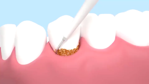 Ultrasonic electric teeth cleaner plaque remover electric teeth cleaner polisher powerful smart electric teeth cleaner