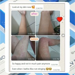 NOURRI - Harmony Combo (1 Nourri Skin Essence + 1 RCV PRO) for Eczema Psoriasis Dry Sensitive Skin