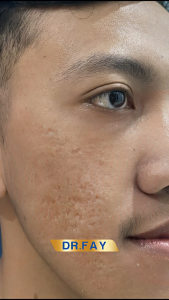 Penghilang Bekas Jerawat & Flek Hitam dengan Cream Dr FAY Original BPOM