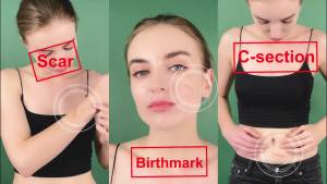 🇸🇬#1 SCAR treatment scar removal scar patch scar sticker ALIVER silicone scar sheet 1.6" x 120" (4cm x 300cm) roll
