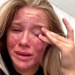 SKIN ANTI-ITCH CREAM Skin Therapy Healing Cream Anti-Itch Antibacterial Psoriasis Treatment