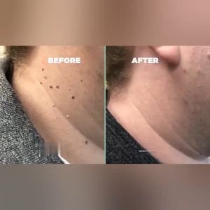 wart remover warts removal cream 10ml skin tag removal mole remover cream Skin repair and inhibit bacteria suitable for all skin types mild and non irritating