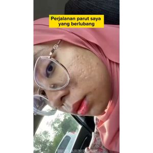 Verble Serum Pitted Scar Reduce dark spots Brighten skin Regenerate skin 30ml