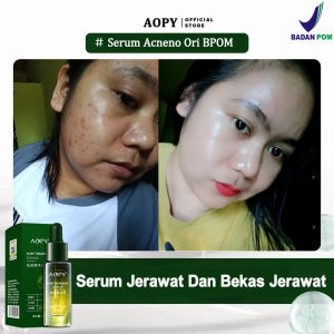 Serum Acne AOPY: Solusi Jerawat & Pori-Pori