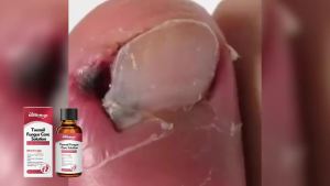 Nail Fungus Treatment Serum Restore Discolor Damage Nails Anti Infection Treatment Paronychia Removal Onychomycosis Care Essence
