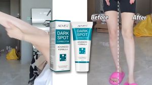 ALIVER Dark Spot Corrector Cream-Age Spots Remover The whitening serum lightens dark spots sun spots age spots liver spots freckles，Dark Whitening Cream Freckles Whitening Powerful Melasma Removal Melanin Pigmentation