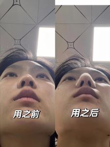 High Nose Bridge up Flat! Since Kneading-Shaped Nasal Splint Thermoplastic Rhinoplasty Brace Becomes Stronger and Increases by Handy Gadget