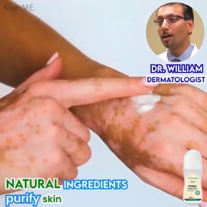 EALF Tinea Versicolor Vitiligo Body Skin Care Cream 30g