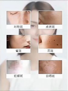 Dark spot removal essence melanin serum freckle removal essence removal chloasma Mobile phone radiation pregnancy genetic age spots halp whitening