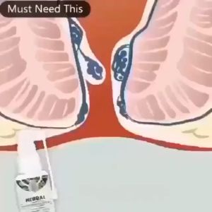 Hemorrhoid Treatment Spray Natural Herbal Essence No Stimulation Hemorrhoids Spray Hemorrhoids Treatment Agent External Fissure 30ml