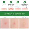 Hydrocolloid Mụn Miếng Dán Vết Thâm Do Dán 24/36 Chiếc Thoáng Khí Chống Thấm Nước Nhẹ Nhàng Không Gây Kích Ứng Da & Chăm Sóc Da Mặt Cho Ốp Lưng. 