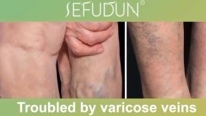 SEFUDUN Varicose Vein Cream Varicose Vein Treatment Cream Effective Angiitis Ointment Remove Spider Vein Pain Killer Cream