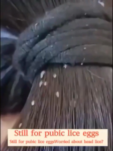 Buy 1 Take 1 Lice Remover Shampoo Licealiz Head Lice Treatment Shampoo Treatment Lice Remover Shampoo The Lice Removal Spray Is Gentle And Non-Irritating And Suitable For Children And Adults 200ml