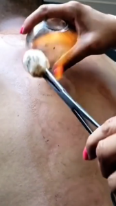 Bộ Dụng Cụ Giác Hơi 12 Ly Không Dùng Lửa Tiện Dụng