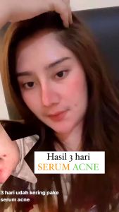 Orlin Beauty Serum Acne 10ml Mencerahkan Mengecilkan Pori Mengurangi Bekas Jerawat Bopeng Skincare BPOM