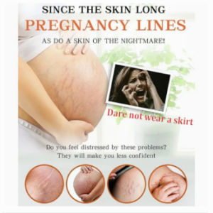 Remove Stretch Mark Cream Pregnant Cream (Safe Halal) Nourish Moisturizing Anti-wrinkle Remove Obesity Tattoo Care Firming Body Cream Stretch Marks Treatment