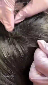 TEN TWENTY Lice Remover Shampoo Anti-Dandruff Deep Cleansing Hair Nourishing Natural 300ml