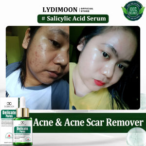 Remove acne marks and pits serum Salicylic Acid Serum 30ml Blemish & Scar Removing & Brightening Facial Serum Remove blackheads Shrink pores and smooth skin For Oiled And Acne skin