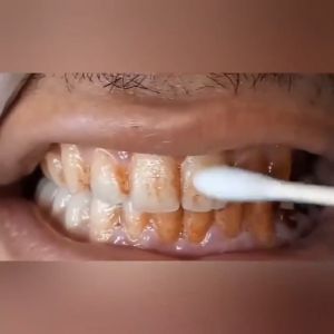 EELHOE Teeth Whitening Essence Powder Oral Hygiene Cleaning Serum Removes Plaque / Pemutih Gigi Kuning dan Karang Permanen / Pembersih Perontok Karang Gigi dan Bau Mulut / Dazzling White Pen